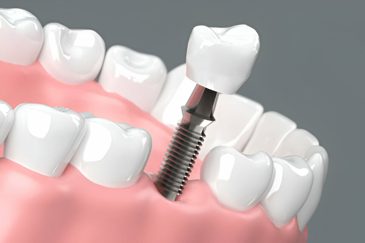 same-day dental  implants edmonton